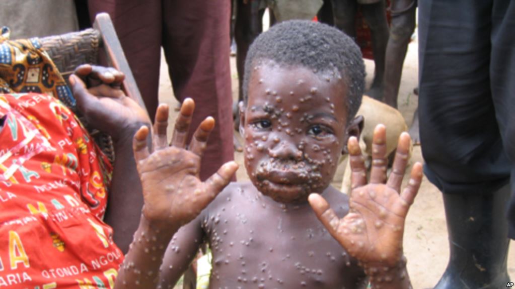 Monkey Pox: LUTH and NCDC promises to fight deadly disease