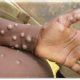 Four new cases of Monkeypox: 301 Nationwide