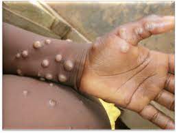 Four new cases of Monkeypox: 301 Nationwide